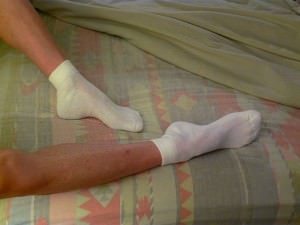 Restless Leg Syndrome Symptoms
