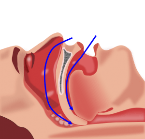 Sleep Apnea - Types and Treatment