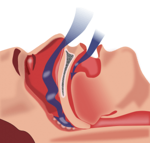 Sleep Apnea and Sleep